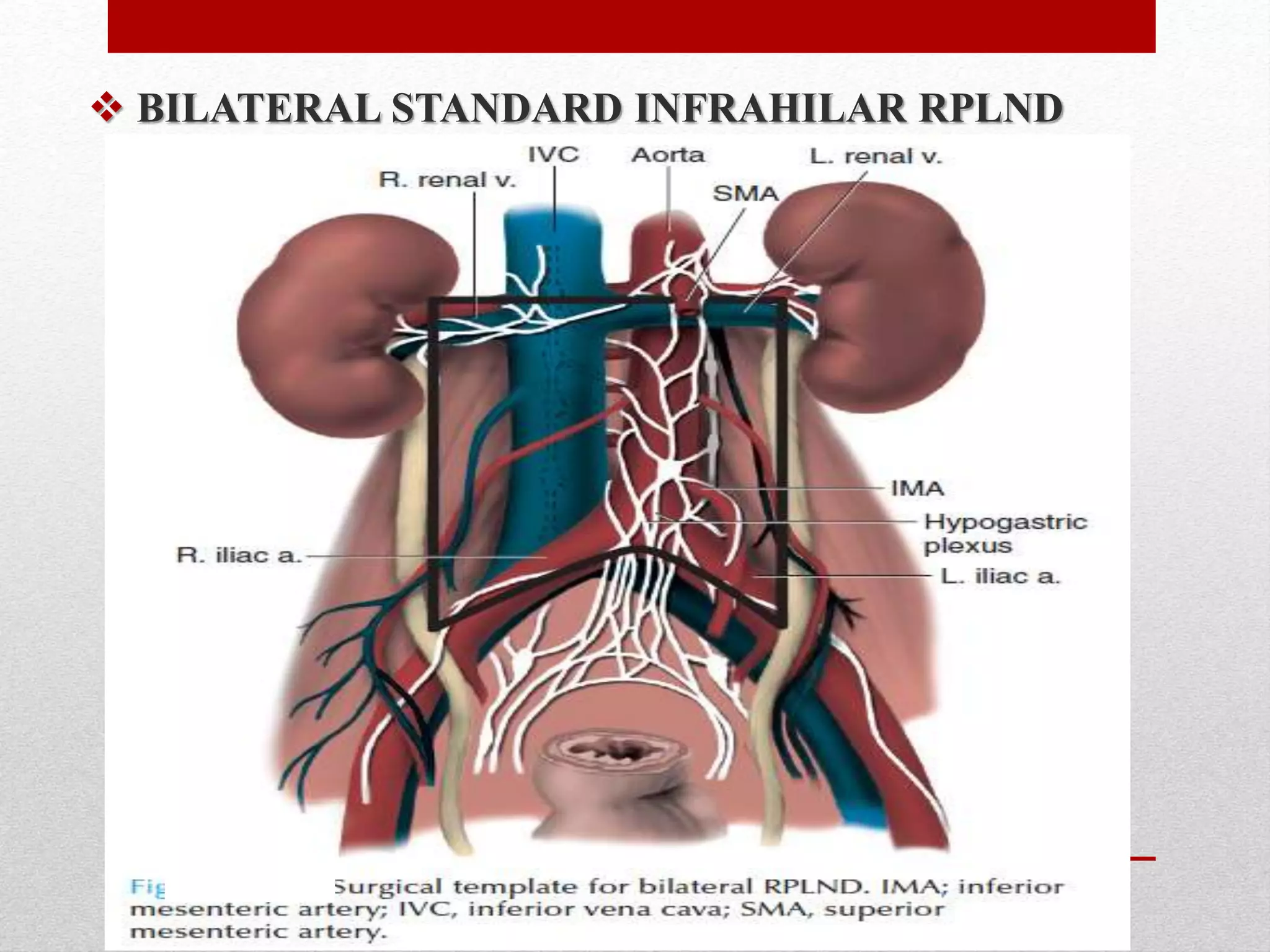  BILATERAL STANDARD INFRAHILAR RPLND
 