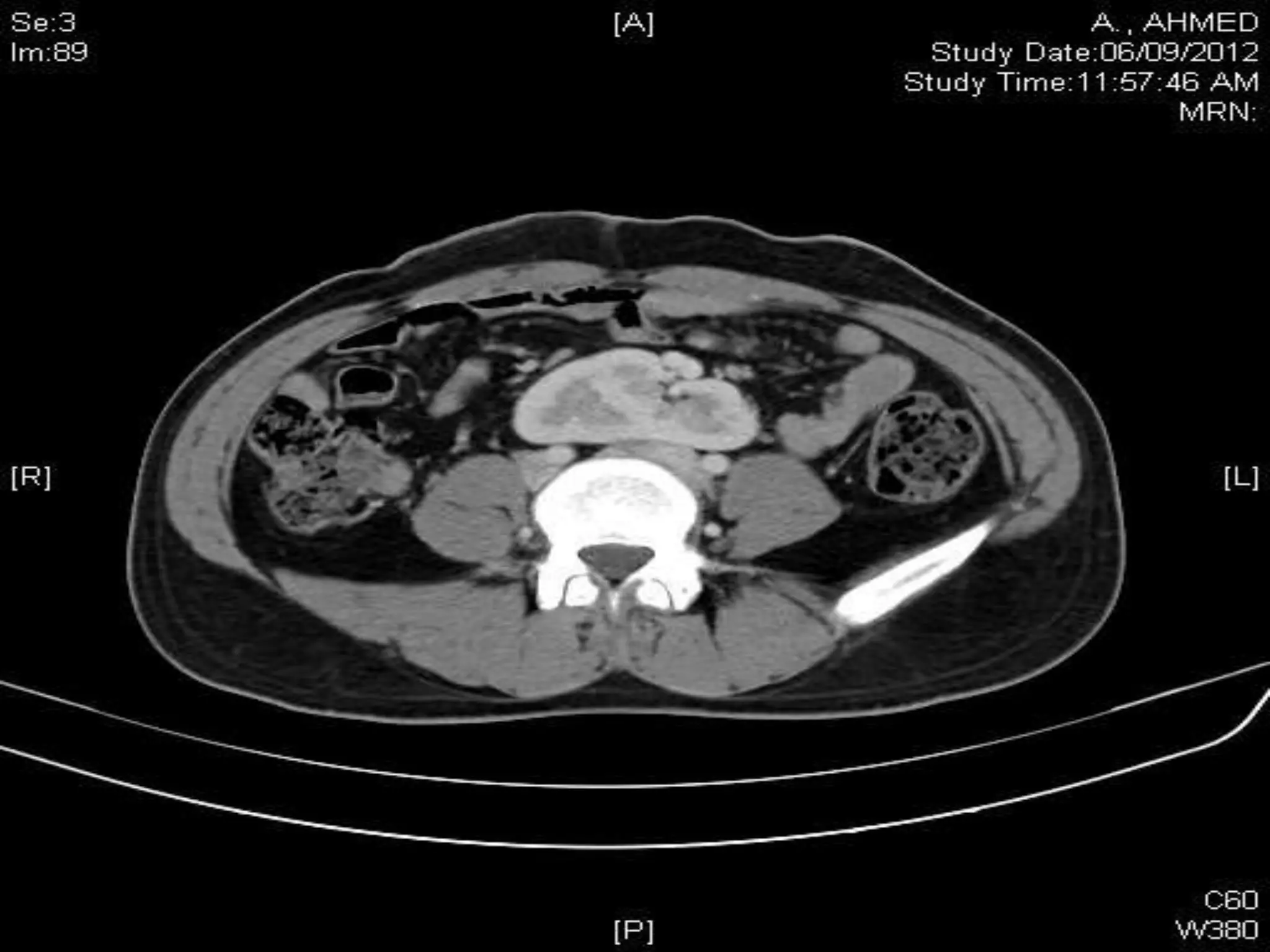 Retroperitoneal lymph node dissection kaushal