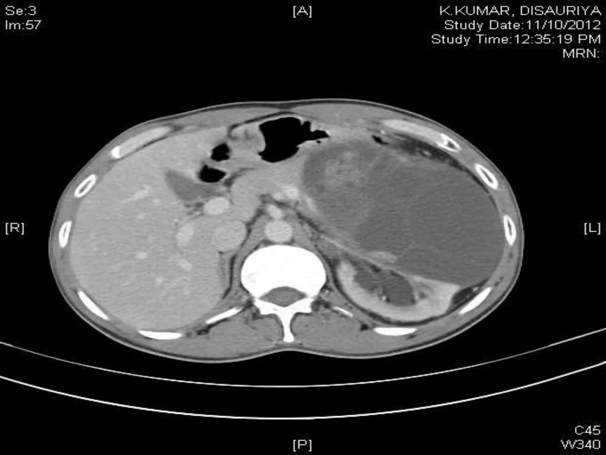 Retroperitoneal lymph node dissection kaushal