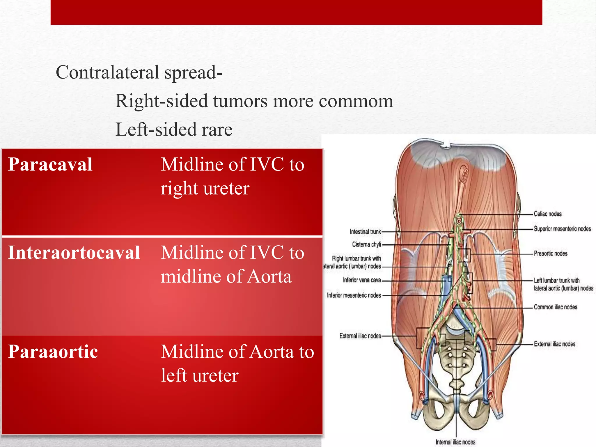 Contralateral spread-
Right-sided tumors more commom
Left-sided rare
Paracaval Midline of IVC to
right ureter
Interaortocaval Midline of IVC to
midline of Aorta
Paraaortic Midline of Aorta to
left ureter
 