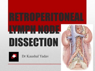 RETROPERITONEAL
LYMPH NODE
DISSECTION
Dr Kaushal Yadav
 