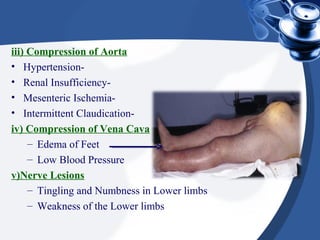 iii) Compression of Aorta
• Hypertension-
• Renal Insufficiency-
• Mesenteric Ischemia-
• Intermittent Claudication-
iv) Compression of Vena Cava
– Edema of Feet
– Low Blood Pressure
v)Nerve Lesions
– Tingling and Numbness in Lower limbs
– Weakness of the Lower limbs
 