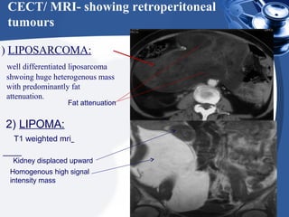 CECT/ MRI- showing retroperitoneal
tumours
1) LIPOSARCOMA:
well differentiated liposarcoma
shwoing huge heterogenous mass
with predominantly fat
attenuation.
Fat attenuation
2) LIPOMA:
T1 weighted mri
Homogenous high signal
intensity mass
Kidney displaced upward
 