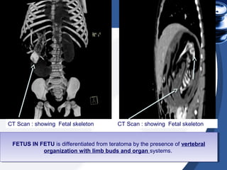 CT Scan : showing Fetal skeleton CT Scan : showing Fetal skeleton
FETUS IN FETU is differentiated from teratoma by the presence of vertebral
organization with limb buds and organ systems.
FETUS IN FETU is differentiated from teratoma by the presence of vertebral
organization with limb buds and organ systems.
 