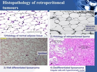 Histopathology of retroperitoneal
tumours
1)Histology of normal adipose tissue 2) Histology of retroperitoneal lipoma
3) Well differentiated liposarcoma 4) Dedifferentiated liposarcoma
Irregular cells with hyperchromatic nuclei
Mature white
cell with no
pleomorphism
lipoblast
 