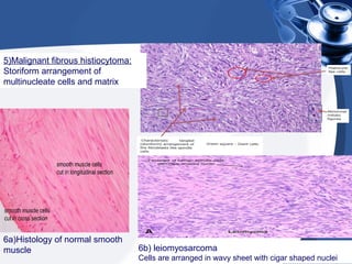 5)Malignant fibrous histiocytoma:
Storiform arrangement of
multinucleate cells and matrix
6b) leiomyosarcoma
Cells are arranged in wavy sheet with cigar shaped nuclei
6a)Histology of normal smooth
muscle
 