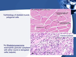 7b) Rhabdomyosarcoma
eosinophilic granular cytoplasm
with either round or elongated
cells( tadpole)
7a)Histology of skeletal muscle
polygonal cells
rhabdomyoblasts
 