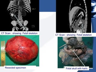 CT Scan : showing Fetal skeleton
CT Scan : showing Fetal skeleton
Resected specimen Fetal skull with hairs
 