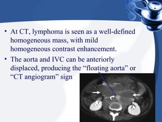 • At CT, lymphoma is seen as a well-defined
homogeneous mass, with mild
homogeneous contrast enhancement.
• The aorta and IVC can be anteriorly
displaced, producing the “floating aorta” or
“CT angiogram” sign
 