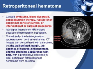 Retroperitoneal hematoma
• Caused by trauma, blood dyscrasia,
anticoagulation therapy, rupture of an
abdominal aortic aneurysm, or
interventional or surgical procedures.
• low signal intensity on MR images
because of hemosiderin deposition.
• Occasionally, the heterogeneous
appearance on contrast-enhanced CT
images can be confused with a sarcoma,
but the well-defined margin, the
absence of contrast enhancement,
and the changing appearance with
time, with a progressive decrease in
size, distinguish retroperitoneal
hematoma from sarcoma
 