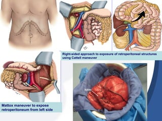 Mattox maneuver to expose
retroperitoneum from left side
Right-sided approach to exposure of retroperitoneal structures
using Cattell maneuver
 