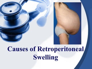 Causes of Retroperitoneal
Swelling
 