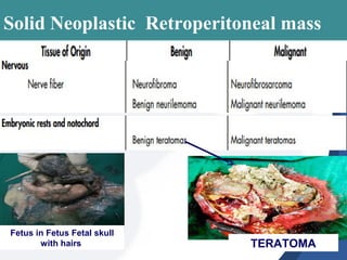 Solid Neoplastic Retroperitoneal mass
Fetus in Fetus Fetal skull
with hairs TERATOMA
 