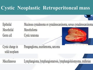 Cystic Neoplastic Retroperitoneal mass
 