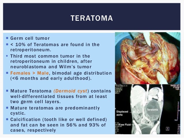 Retroperitoneal mass