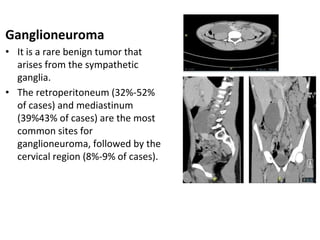 Ganglioneuroma
• It is a rare benign tumor that
arises from the sympathetic
ganglia.
• The retroperitoneum (32%-52%
of cases) and mediastinum
(39%43% of cases) are the most
common sites for
ganglioneuroma, followed by the
cervical region (8%-9% of cases).
 