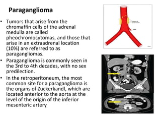 • Tumors that arise from the
chromaffin cells of the adrenal
medulla are called
pheochromocytomas, and those that
arise in an extraadrenal location
(10%) are referred to as
paragangliomas.
• Paraganglioma is commonly seen in
the 3rd to 4th decades, with no sex
predilection.
• In the retroperitoneum, the most
common site for a paraganglioma is
the organs of Zuckerkandl, which are
located anterior to the aorta at the
level of the origin of the inferior
mesenteric artery
Paraganglioma
 