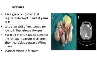 Teratoma
• It is a germ cell tumor that
originates from pluripotent germ
cells
• Less than 10% of teratomas are
found in the retroperitoneum.
• It is third most common tumor in
the retroperitoneum in children,
after neuroblastoma and Wilms
tumor.
• More common in females
 