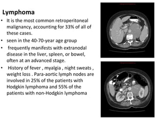 Lymphoma
• It is the most common retroperitoneal
malignancy, accounting for 33% of all of
these cases.
• seen in the 40-70-year age group
• frequently manifests with extranodal
disease in the liver, spleen, or bowel,
often at an advanced stage.
• History of fever , myalgia , night sweats ,
weight loss . Para-aortic lymph nodes are
involved in 25% of the patients with
Hodgkin lymphoma and 55% of the
patients with non-Hodgkin lymphoma
 