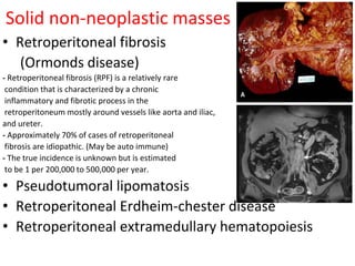 Solid non-neoplastic masses
• Retroperitoneal fibrosis
(Ormonds disease)
- Retroperitoneal fibrosis (RPF) is a relatively rare
condition that is characterized by a chronic
inflammatory and fibrotic process in the
retroperitoneum mostly around vessels like aorta and iliac,
and ureter.
- Approximately 70% of cases of retroperitoneal
fibrosis are idiopathic. (May be auto immune)
- The true incidence is unknown but is estimated
to be 1 per 200,000 to 500,000 per year.
• Pseudotumoral lipomatosis
• Retroperitoneal Erdheim-chester disease
• Retroperitoneal extramedullary hematopoiesis
 