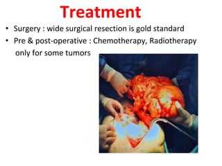 Treatment
• Surgery : wide surgical resection is gold standard
• Pre & post-operative : Chemotherapy, Radiotherapy
only for some tumors
 
