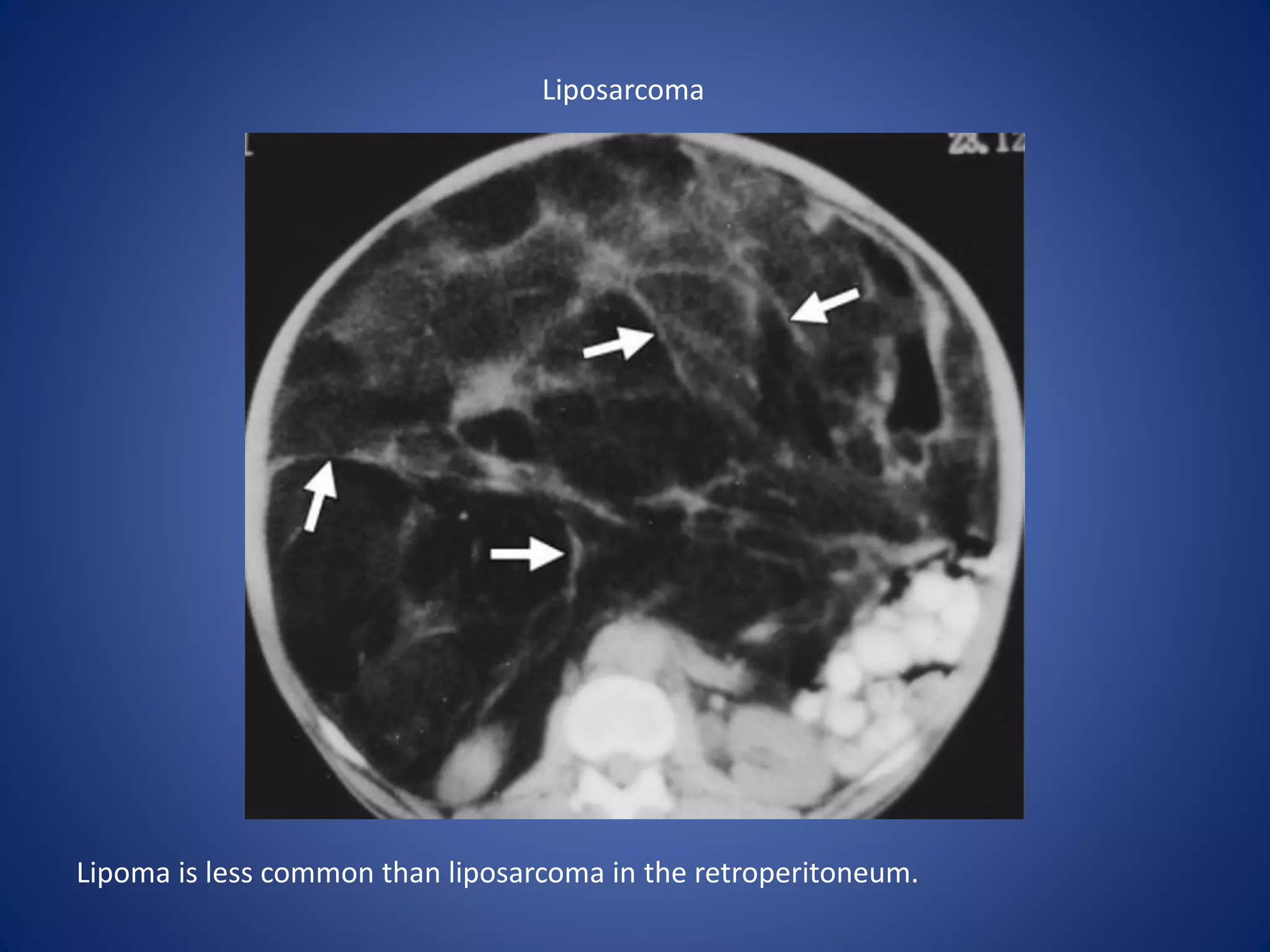 Liposarcoma
Lipoma is less common than liposarcoma in the retroperitoneum.
 