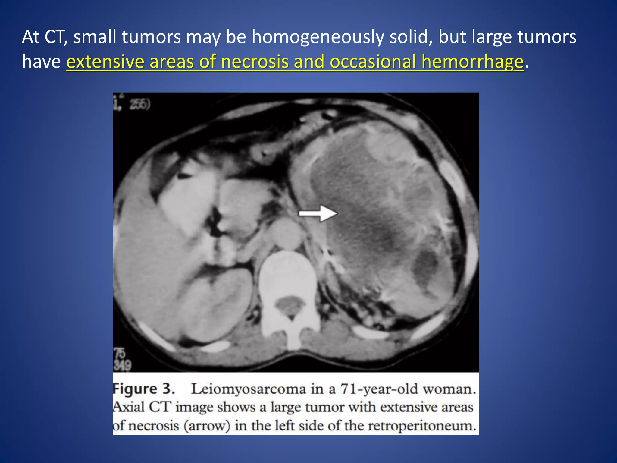 At CT, small tumors may be homogeneously solid, but large tumors
have extensive areas of necrosis and occasional hemorrhage.
 