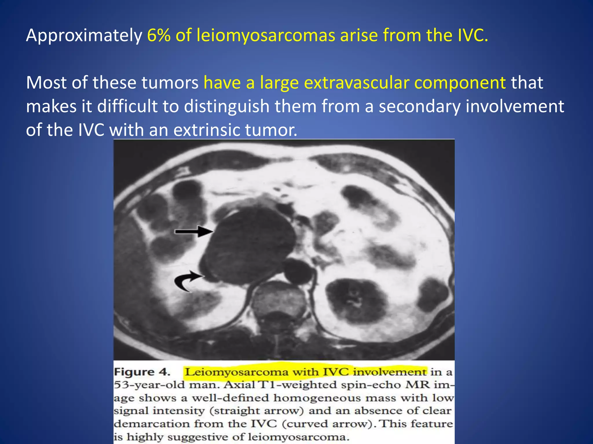 Approximately 6% of leiomyosarcomas arise from the IVC.
Most of these tumors have a large extravascular component that
makes it difficult to distinguish them from a secondary involvement
of the IVC with an extrinsic tumor.
 