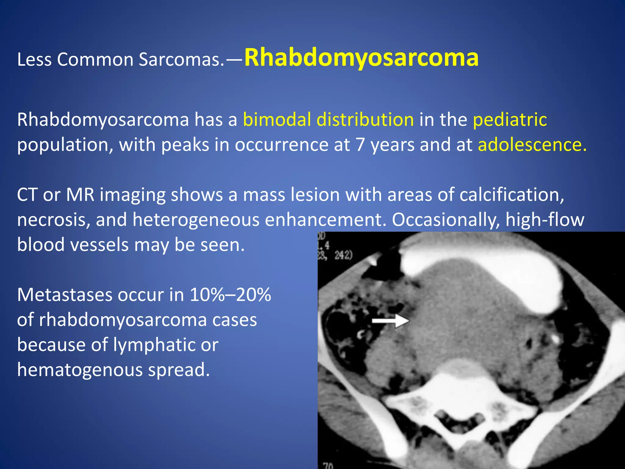 Less Common Sarcomas.—Rhabdomyosarcoma
Rhabdomyosarcoma has a bimodal distribution in the pediatric
population, with peaks in occurrence at 7 years and at adolescence.
CT or MR imaging shows a mass lesion with areas of calcification,
necrosis, and heterogeneous enhancement. Occasionally, high-flow
blood vessels may be seen.
Metastases occur in 10%–20%
of rhabdomyosarcoma cases
because of lymphatic or
hematogenous spread.
 