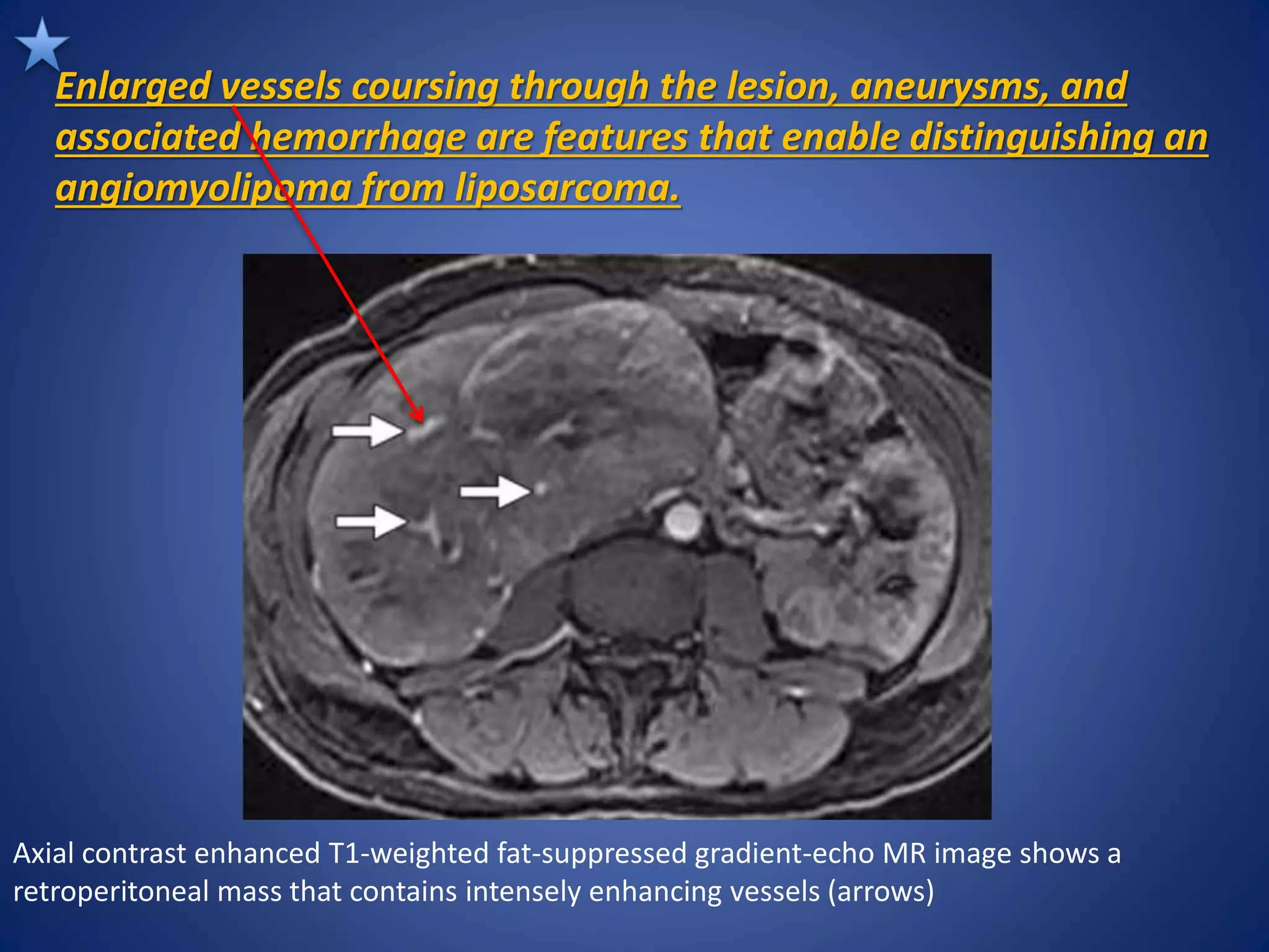 Enlarged vessels coursing through the lesion, aneurysms, and
associated hemorrhage are features that enable distinguishing an
angiomyolipoma from liposarcoma.
Axial contrast enhanced T1-weighted fat-suppressed gradient-echo MR image shows a
retroperitoneal mass that contains intensely enhancing vessels (arrows)
 