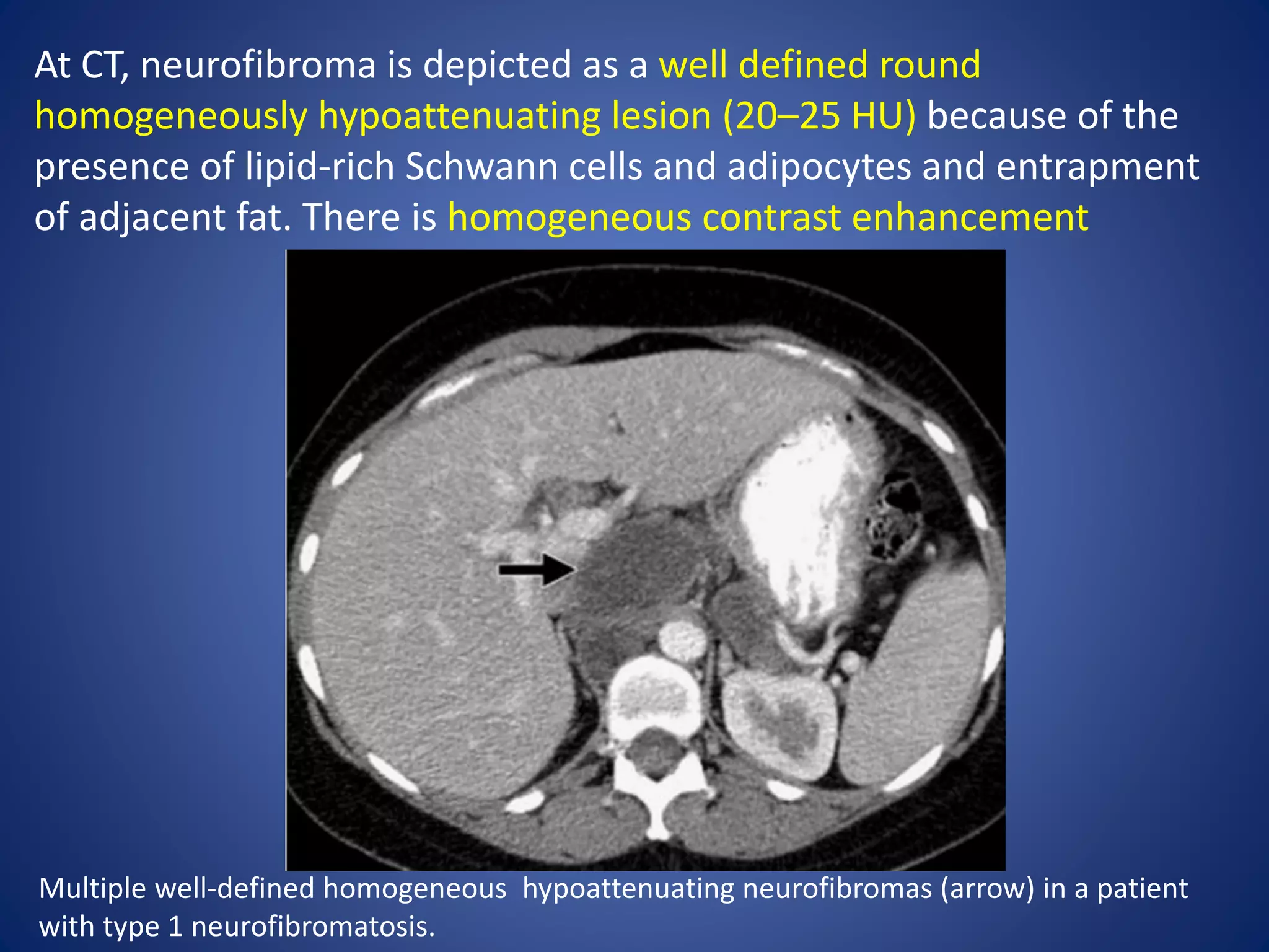 At CT, neurofibroma is depicted as a well defined round
homogeneously hypoattenuating lesion (20–25 HU) because of the
presence of lipid-rich Schwann cells and adipocytes and entrapment
of adjacent fat. There is homogeneous contrast enhancement
Multiple well-defined homogeneous hypoattenuating neurofibromas (arrow) in a patient
with type 1 neurofibromatosis.
 