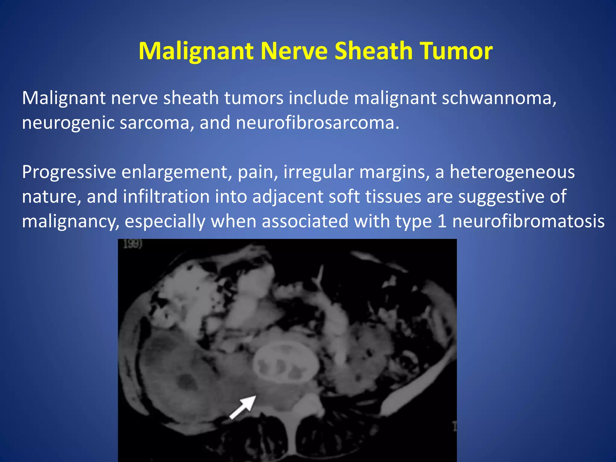 Malignant Nerve Sheath Tumor
Malignant nerve sheath tumors include malignant schwannoma,
neurogenic sarcoma, and neurofibrosarcoma.
Progressive enlargement, pain, irregular margins, a heterogeneous
nature, and infiltration into adjacent soft tissues are suggestive of
malignancy, especially when associated with type 1 neurofibromatosis
 