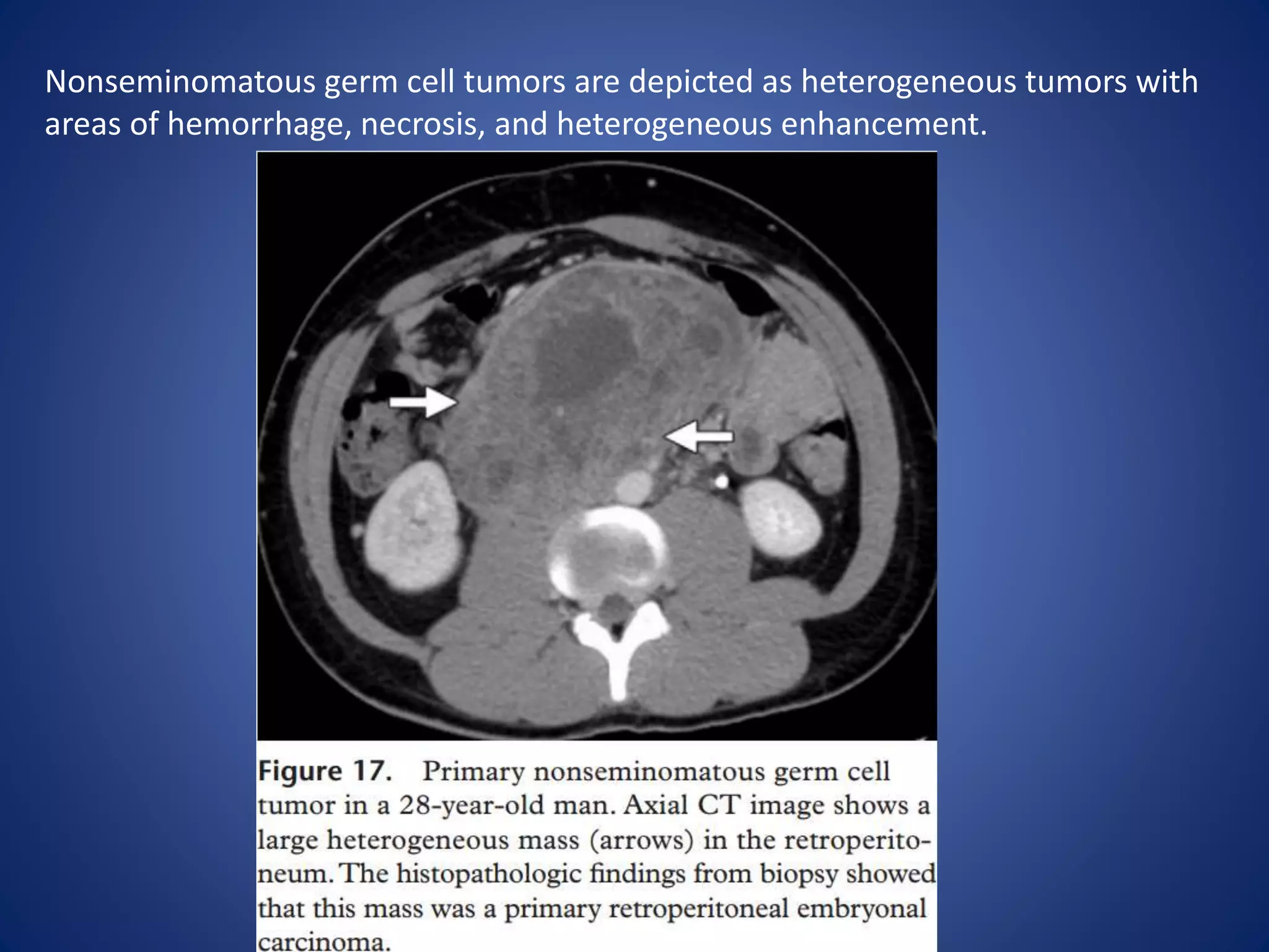 Nonseminomatous germ cell tumors are depicted as heterogeneous tumors with
areas of hemorrhage, necrosis, and heterogeneous enhancement.
 