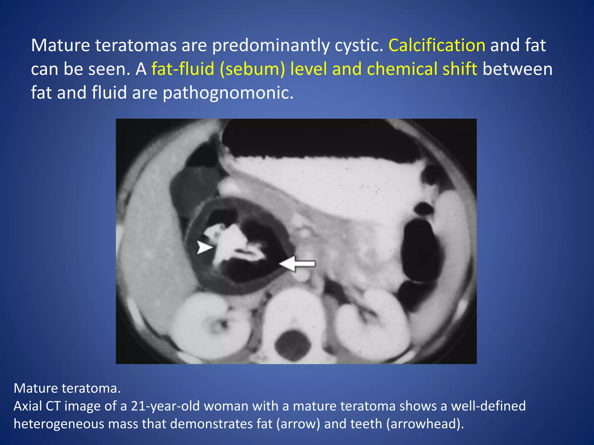 Mature teratomas are predominantly cystic. Calcification and fat
can be seen. A fat-fluid (sebum) level and chemical shift between
fat and fluid are pathognomonic.
Mature teratoma.
Axial CT image of a 21-year-old woman with a mature teratoma shows a well-defined
heterogeneous mass that demonstrates fat (arrow) and teeth (arrowhead).
 