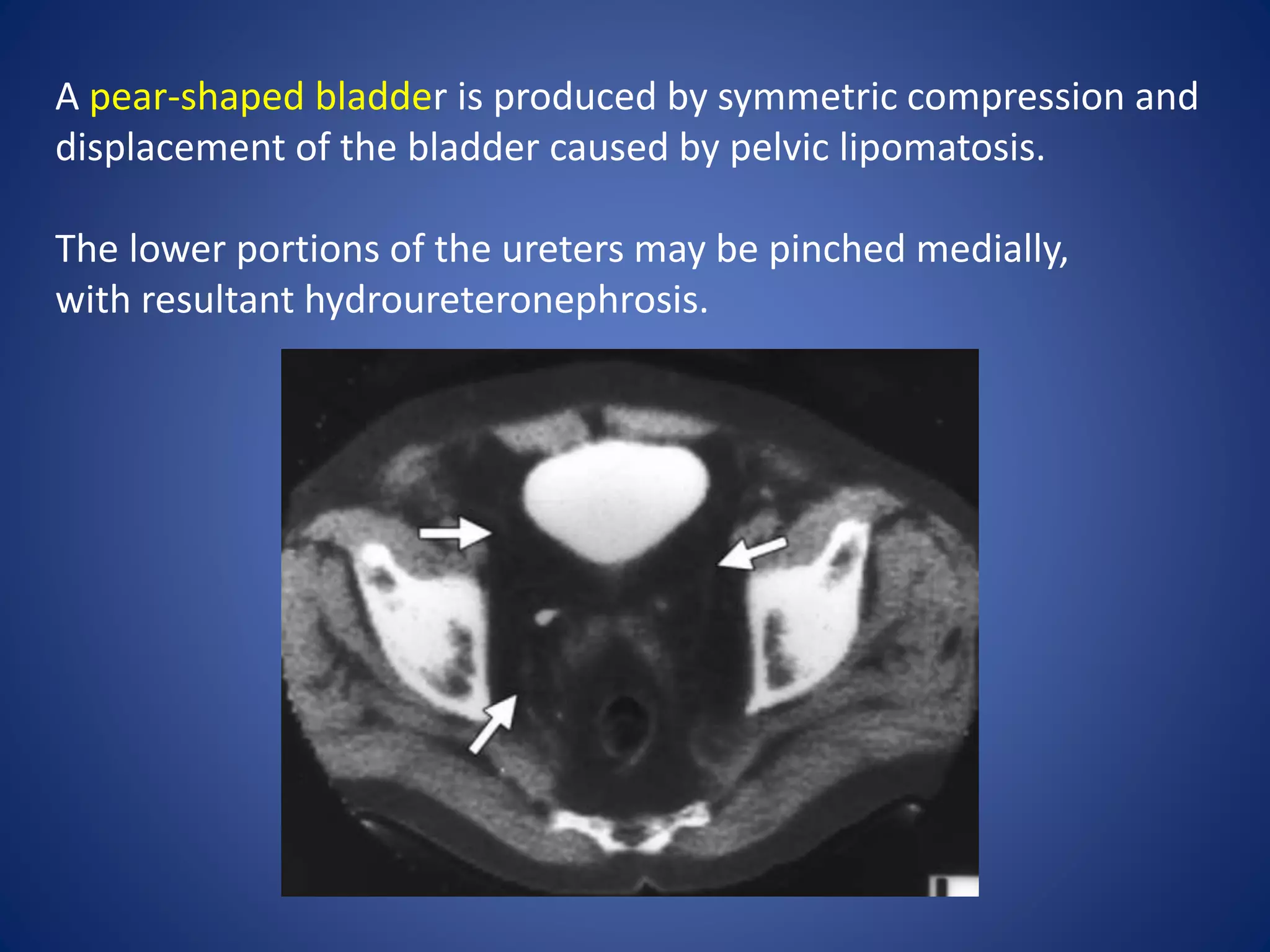 A pear-shaped bladder is produced by symmetric compression and
displacement of the bladder caused by pelvic lipomatosis.
The lower portions of the ureters may be pinched medially,
with resultant hydroureteronephrosis.
 