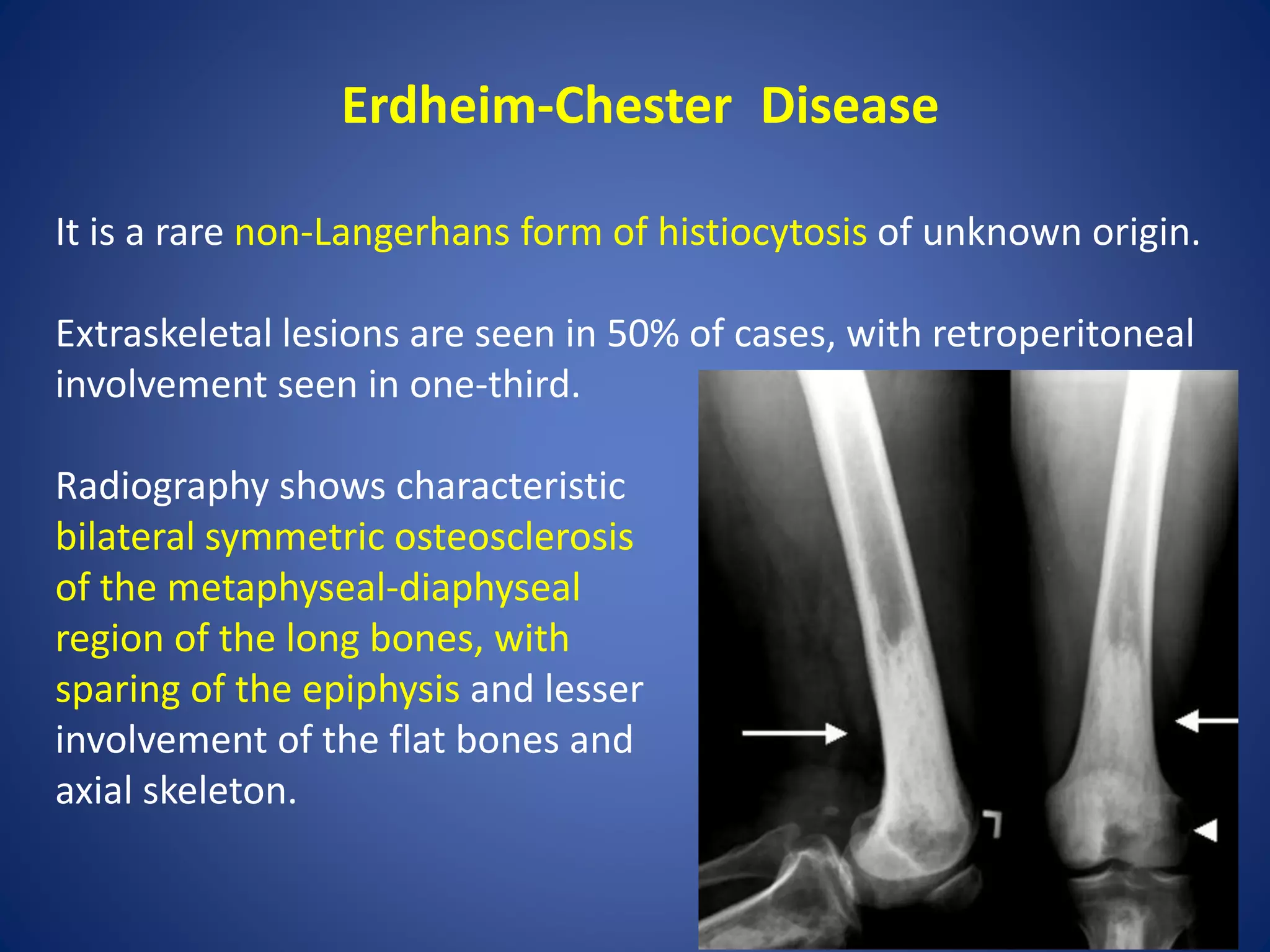 Erdheim-Chester Disease
It is a rare non-Langerhans form of histiocytosis of unknown origin.
Extraskeletal lesions are seen in 50% of cases, with retroperitoneal
involvement seen in one-third.
Radiography shows characteristic
bilateral symmetric osteosclerosis
of the metaphyseal-diaphyseal
region of the long bones, with
sparing of the epiphysis and lesser
involvement of the flat bones and
axial skeleton.
 