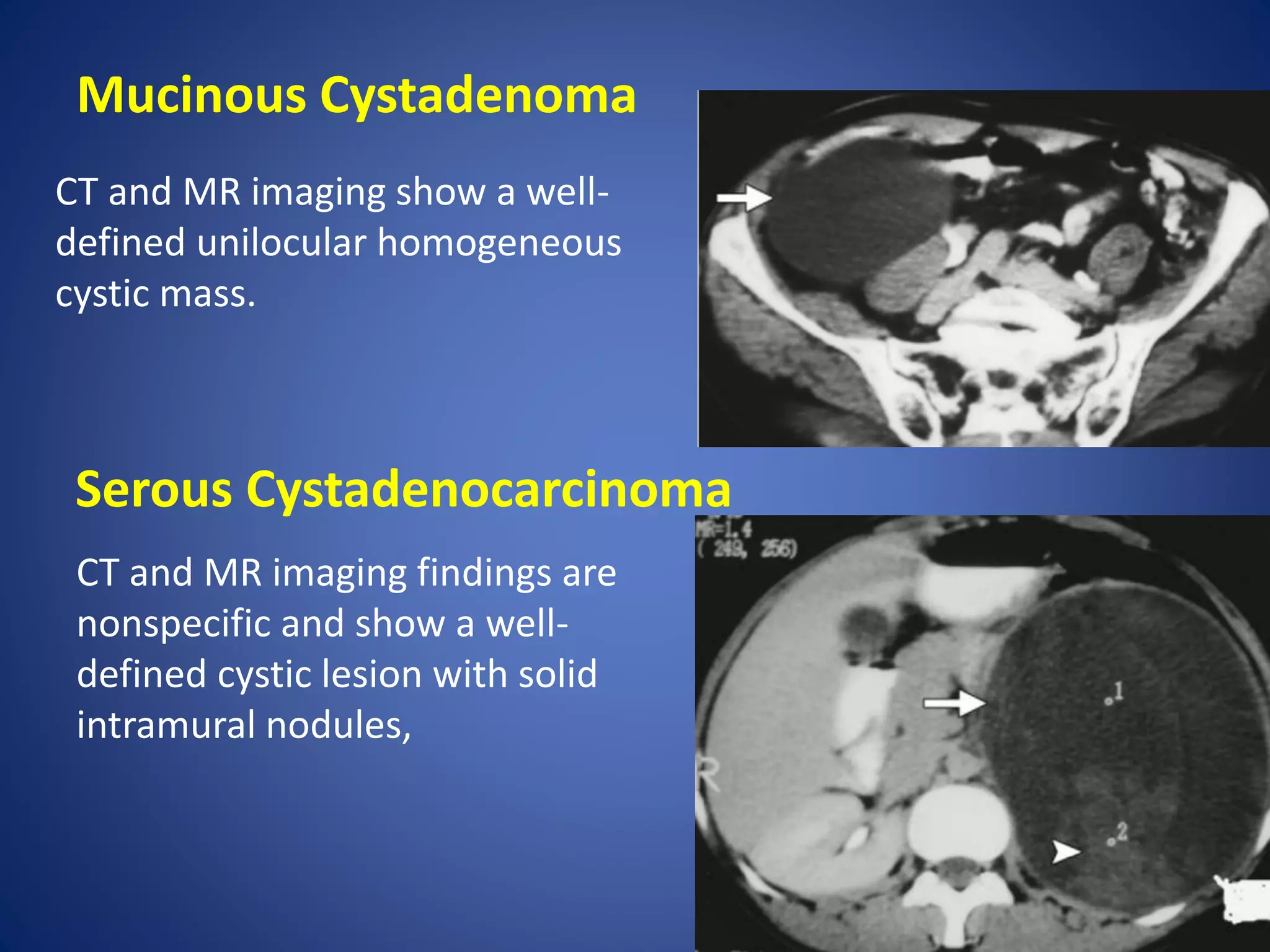 Mucinous Cystadenoma
Serous Cystadenocarcinoma
CT and MR imaging show a well-
defined unilocular homogeneous
cystic mass.
CT and MR imaging findings are
nonspecific and show a well-
defined cystic lesion with solid
intramural nodules,
 
