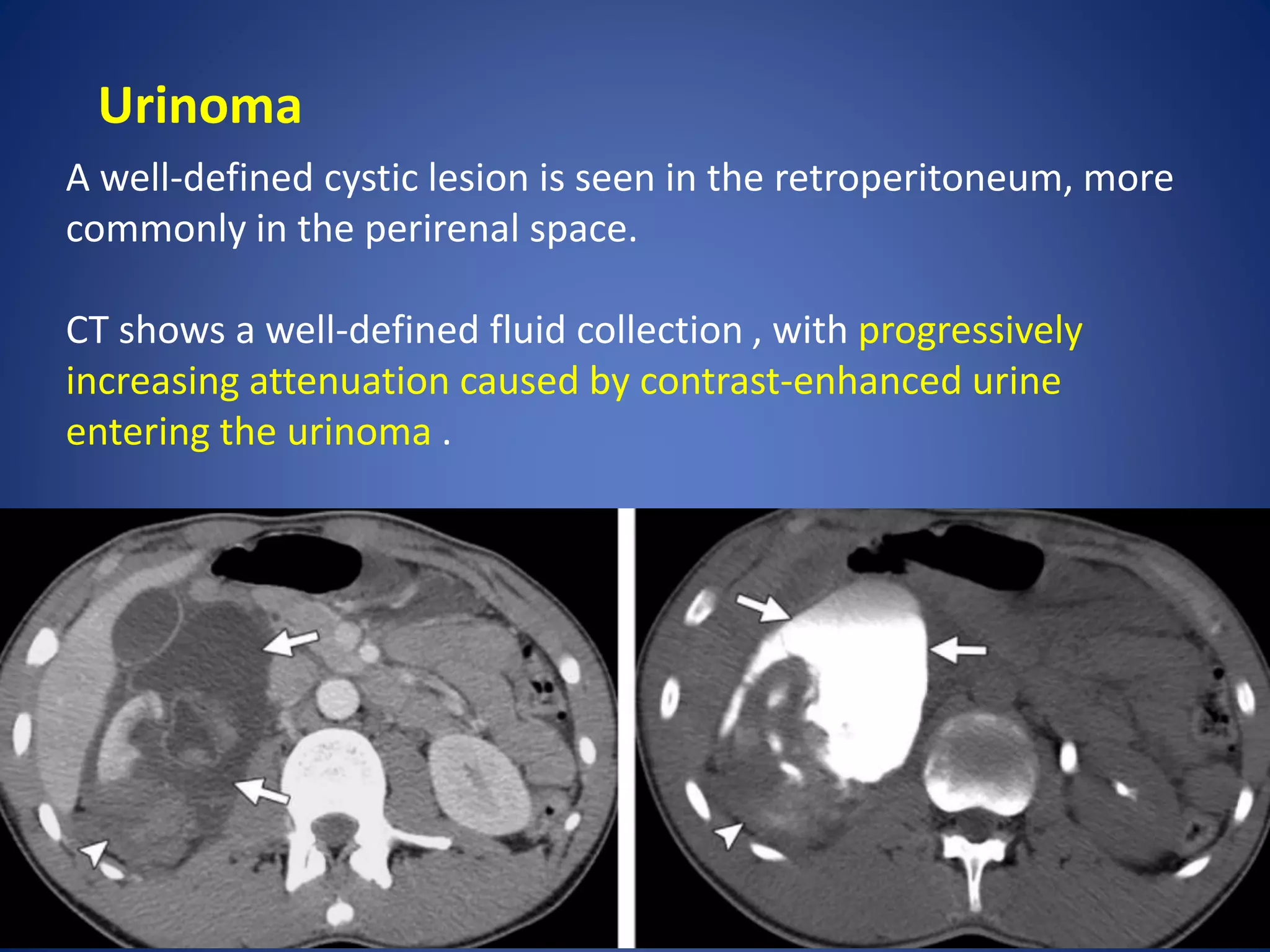 Urinoma
A well-defined cystic lesion is seen in the retroperitoneum, more
commonly in the perirenal space.
CT shows a well-defined fluid collection , with progressively
increasing attenuation caused by contrast-enhanced urine
entering the urinoma .
 