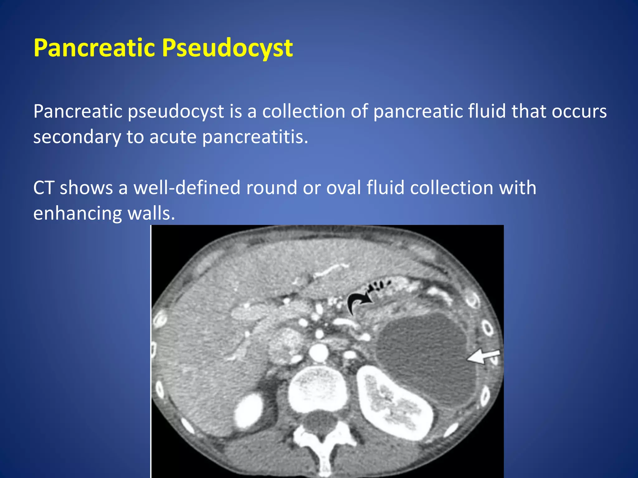Pancreatic Pseudocyst
Pancreatic pseudocyst is a collection of pancreatic fluid that occurs
secondary to acute pancreatitis.
CT shows a well-defined round or oval fluid collection with
enhancing walls.
 
