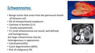 Schwannoma.
• Benign tumor that arises from the perineural sheath
of Schwann cell.
• 6% of retroperitoneal neoplasms
• Common in females (2:1)
• Usually asymptomatic.
• CT, small schwannomas are round, well defined,
and homogeneous,
but large schwannomas may be
heterogeneous in appearance.
• Calcification(23%)
• Cystic degenerations (66%).
• Risk of malignancy 5% 17
 
