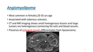 Angiomyolipoma
• Most common in females,20-35 yrs age
• Associated with tuberous sclerosis.
• CT and MR imaging shows small homogenous lesions and large
tumors are heterogenous containing fat cells and blood vessels.
• Presence of enlarged vessels differentiates from liposarcoma.
19
 