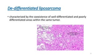 De-differentiated liposarcoma
• characterized by the coexistence of well-differentiated and poorly
differentiated areas within the same tumor.
26
 