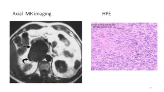 Axial MR imaging HPE
29
 