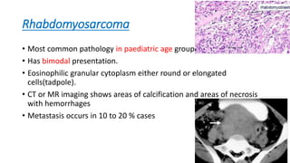 Rhabdomyosarcoma
• Most common pathology in paediatric age group.
• Has bimodal presentation.
• Eosinophilic granular cytoplasm either round or elongated
cells(tadpole).
• CT or MR imaging shows areas of calcification and areas of necrosis
with hemorrhages
• Metastasis occurs in 10 to 20 % cases
31
 
