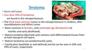 Teratoma.
• Germ cell tumor
• Less than 10% of teratomas
are found in the retroperitoneum.
• The third most common tumor in the retroperitoneum in children, after
neuroblastoma and Wilms tumor
• More common in females, with a bimodal age distribution (<6
months and early adulthood).
• Mature teratoma (dermoid cyst) contains well-differentiated tissues from
at least two germ cell layers.
• Mature teratomas are predominantly cystic.
• Calcification (toothlike or well defined) and fat can be seen in 56% and
93% of cases, respectively 33
 