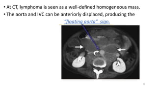 • At CT, lymphoma is seen as a well-defined homogeneous mass.
• The aorta and IVC can be anteriorly displaced, producing the
“floating aorta” sign.
36
 