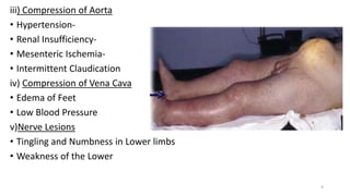 iii) Compression of Aorta
• Hypertension-
• Renal Insufficiency-
• Mesenteric Ischemia-
• Intermittent Claudication
iv) Compression of Vena Cava
• Edema of Feet
• Low Blood Pressure
v)Nerve Lesions
• Tingling and Numbness in Lower limbs
• Weakness of the Lower
9
 