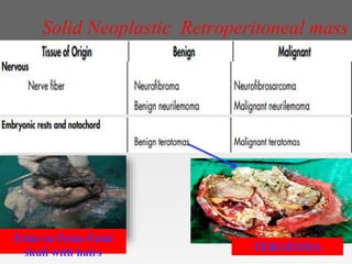 Solid Neoplastic Retroperitoneal mass
Fetus in Fetus Fetal
skull with hairs TERATOMA
 