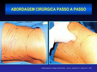 ABORDAGEM CIRÚRGICA PASSO A PASSO Videocirurgia em urologia, Editora Roca, – cap 33 - Eduardo F.C., Maurício R. - 2007 