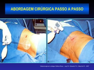 ABORDAGEM CIRÚRGICA PASSO A PASSO Videocirurgia em urologia, Editora Roca, – cap 33 - Eduardo F.C., Maurício R. - 2007 